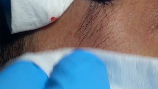 Removing a Milium смотреть онлайн