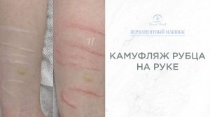Камуфляж рубца на руке