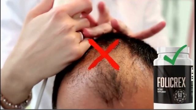 FOLICREX REVIEW ⚠️IMPORTANT ALERT⚠️ FOLICREX HAIR LOSS FOLICREX FOLICREX REVIEWS смотреть онлайн