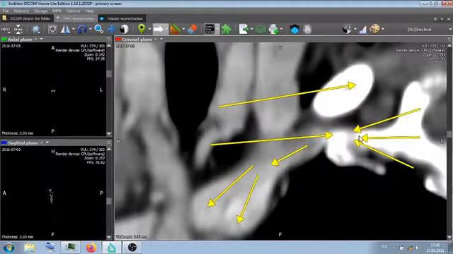 ВЕНОЗНО АРТЕРИАЛЬНЫЙ ШУНТ С КЛАПАНОМ , МЕЖДУ СОННОЙ АРТЕРИЕЙ И ВЕНОЙ . смотреть онлайн
