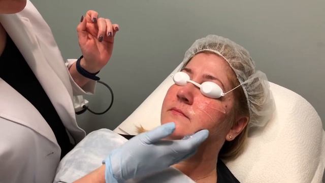 What to Expect Series: IPL-Intense Pulse Light Therapy (Lumecca by Inmode) смотреть онлайн