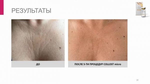 ВЕБИНАР: COLLOST® micro