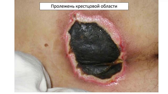 01-02 Клеточная гибель. Некроз. Апоптоз смотреть онлайн