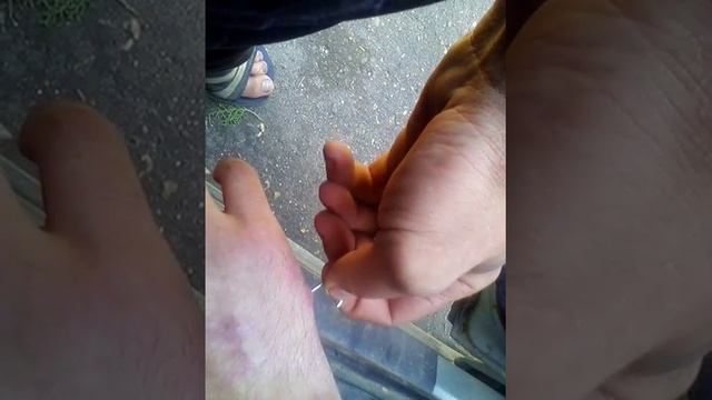 Снятие спицы в домашних условиях смотреть онлайн