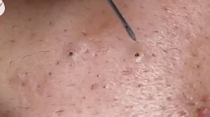 Удаление черных точек 2021