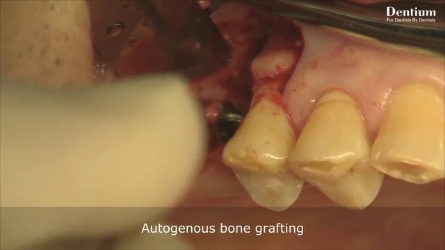 Sinus lifting with simple GBR -modified crestal approach- смотреть онлайн