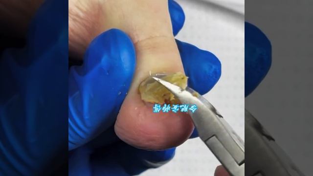 The whole process of super thick onychomycosis repair#magicknife смотреть онлайн