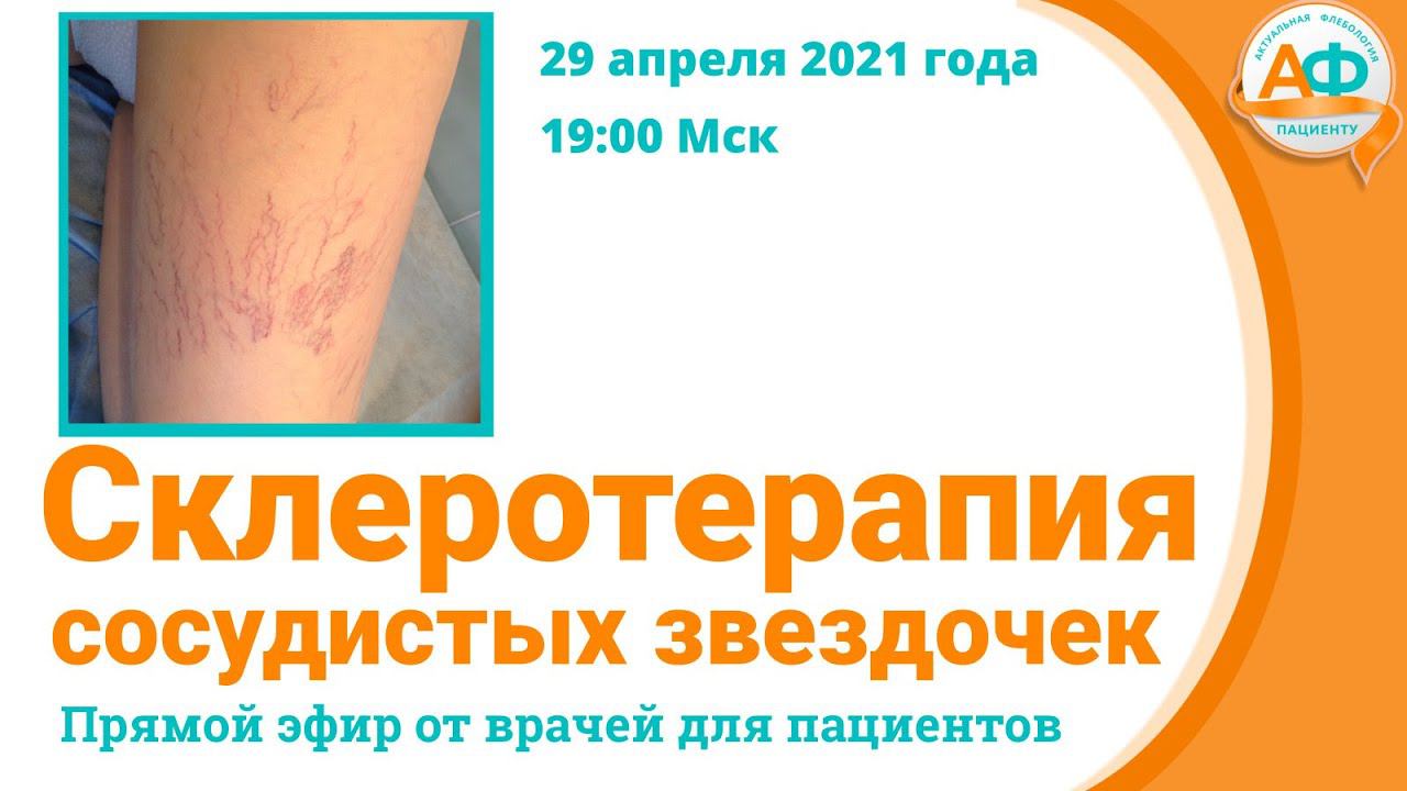 Склеротерапия сосудистых звездочек смотреть онлайн
