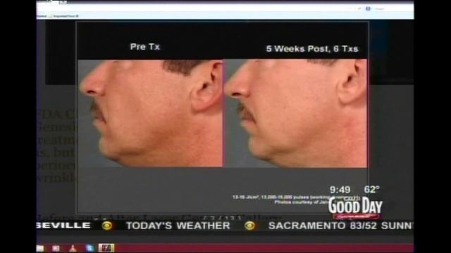 Good Day Sacramento Excel V & Laser Genesis Segment смотреть онлайн