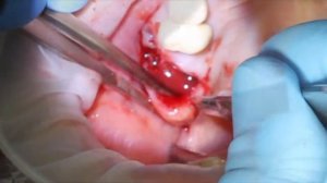 Удаление ретенционной кисты верхнечелюстного синуса