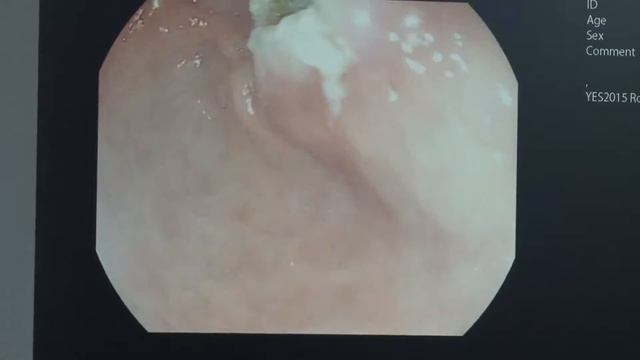 Live03 Ткаченко ОБ EMR Аденомы желудка смотреть онлайн