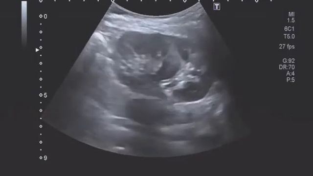 Гипертрофированная колонна Бертина (паренхиматозная перемычка) смотреть онлайн