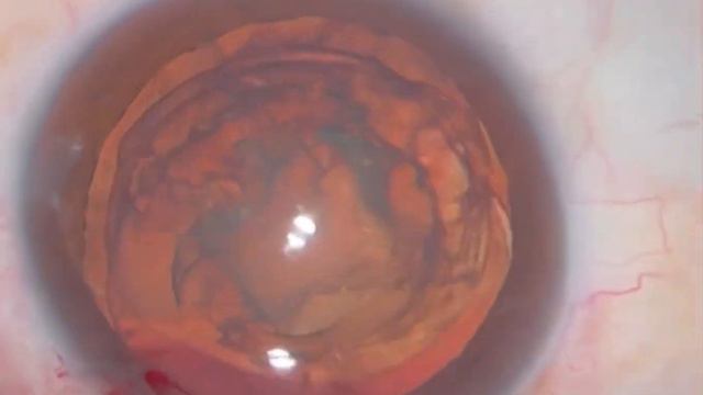 Removal of phakic IOL + Phacoemulsification +IOL implantation. Удаление факичной ИОЛ + ФЭК + ИОЛ смотреть онлайн