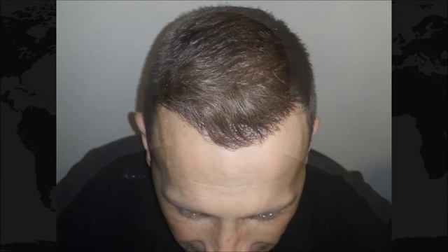 FUE Hair Transplant – Karl’s 30 Month Timeline Result - Hair loss treatment / baldness for Men 2016 смотреть онлайн