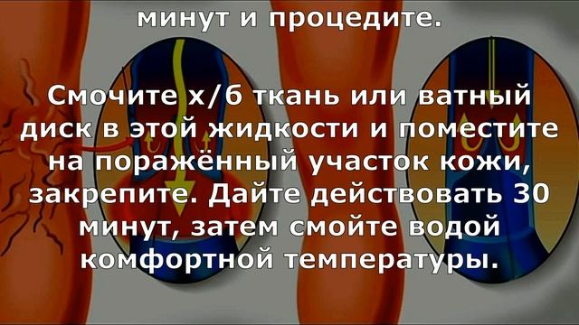 Как избавиться от сосудистой сетки, варикоза, плохой циркуляции крови, тяжести в ногах и усталости! смотреть онлайн