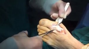 Удаление подагрического тофуса (отложение кристаллов мочевой кислоты в тканях в виде гранулем).