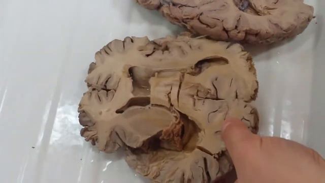 Поперечный разрез полушарий головного мозга часть1 смотреть онлайн