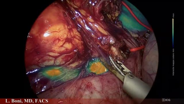 Fluorescent Guided Aorto-Cava and Hepatic Hilum Lymph Nodes Dissection for Recurrent Adrenal Cancer смотреть онлайн