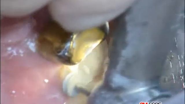 3M ESPE-Фиксация несъемных конструкций