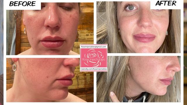 Rose Injectables/ Lumecca/ InMode