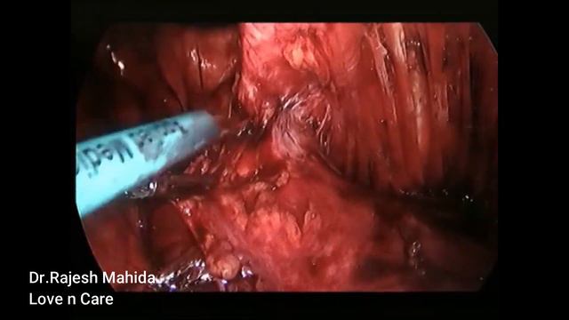 e tep RS with Right side limited TAR in right RIF incisional hernia смотреть онлайн