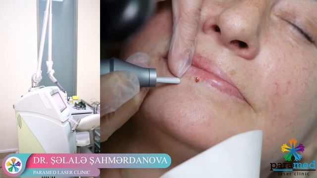İpixel CO2 (Alma Lasers, İsrail ) lazeri vasitəsilə hematomanın aradan götürülməsi. смотреть онлайн