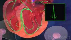 Мерцательная аритмия mp4