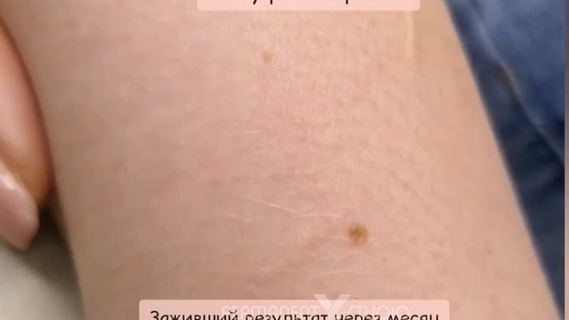 Камуфляж шрамов в Иваново смотреть онлайн