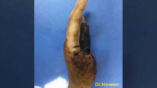 Rattle snake bite: After few hours Thumb finger almost decomposed stage finally amputated смотреть онлайн