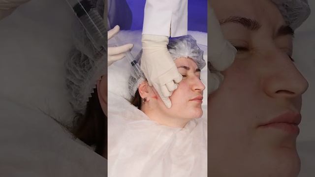Векторный лифтинг жидкими бионитями Derli FIBROLIFT SOFT смотреть онлайн