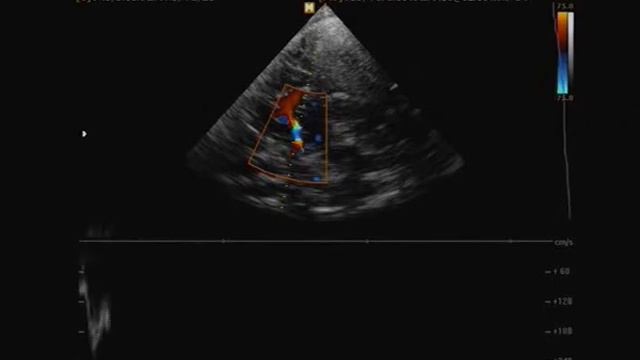 Транскраниальное сканирование - стеноз средней мозговой артерии более 50%. смотреть онлайн