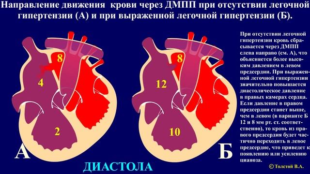 Тема 45.1. Врожденные пороки сердца – дефект межпредсердной перегородки (ДМПП) смотреть онлайн