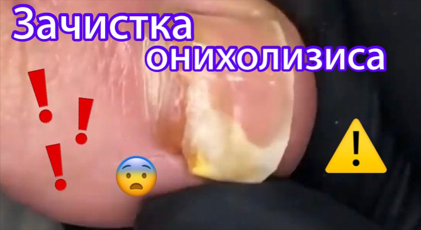 Зачистка онихолизиса ⚠️??? смотреть онлайн
