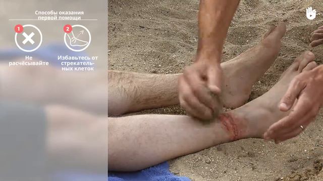 Учись первой помощи: жало медузы смотреть онлайн