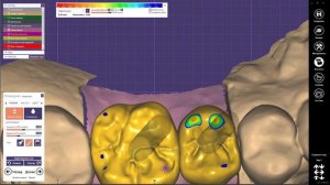 EXOCAD Работа с профилем прорезывания, коронки на винтовой фиксации