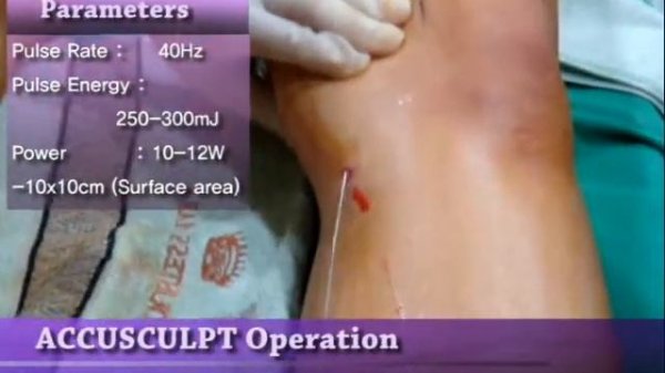 Medial knee ACCUSCULPT procedure