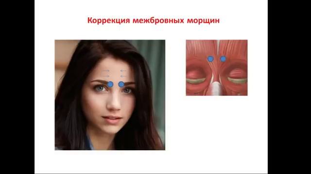 БЕЗ Ботокса: убираем межбровную морщину смотреть онлайн
