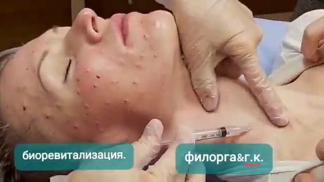 АирисКом студенты учатся: семинар по биоревитализации, филорга для увлажнение кожи лица. смотреть онлайн