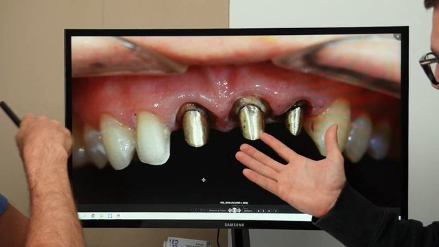 Что делать, если зуб скололся? / Откололся зуб - варианты лечения