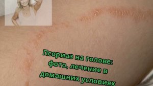 Псориаз на голове: фото, лечение в домашних условиях