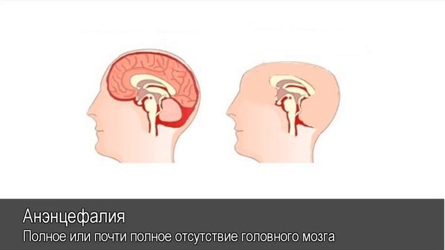 Анэнцефалия. Толковый Видеословарь русского языка смотреть онлайн