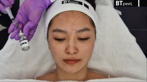 Процедура Азелаиновый пилинг 20% BTpeeL (сокращённая версия)