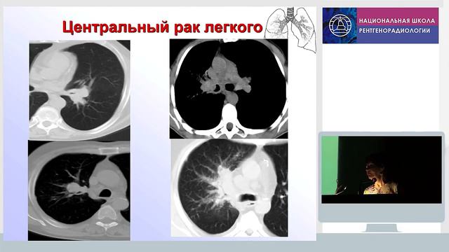 Лучевая диагностика рака легкого смотреть онлайн