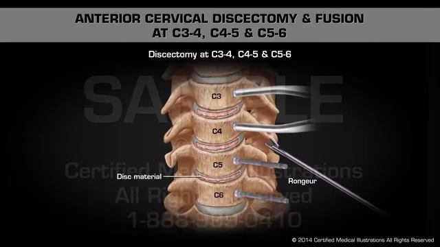 Передне-цервикальная дискэктомия и фиксация позвонков С3-4, С4-5 и С5-6