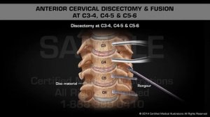 Передне-цервикальная дискэктомия и фиксация позвонков С3-4, С4-5 и С5-6
