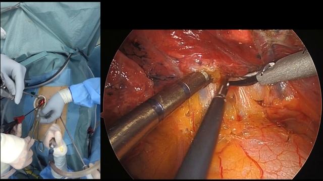 【#100】 DVATS: Dual portal VATS left lower lobectomy with stuck LN смотреть онлайн