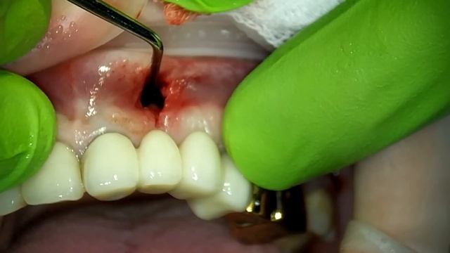 Удаление кисты верхней челюсти