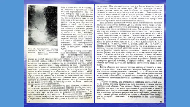 К рентгенодиагностике стенозирующего рака желудка способом двойного контастирования смотреть онлайн