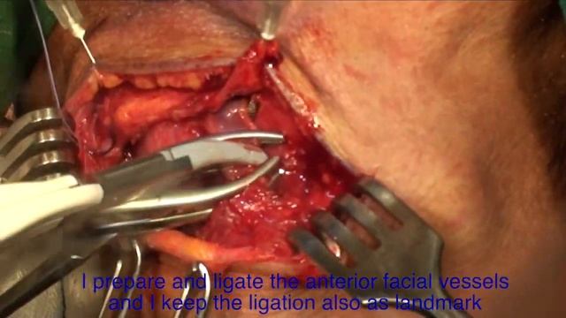 Submandibular salivary gland excision смотреть онлайн