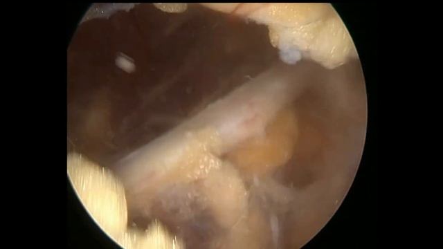 Эндоскопическая декомпрессия плечевого сплетения в области  апертуры и межлестничного пространства.